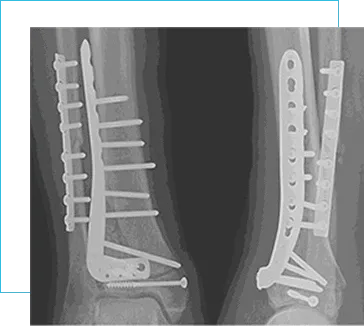 Osteosíntesis